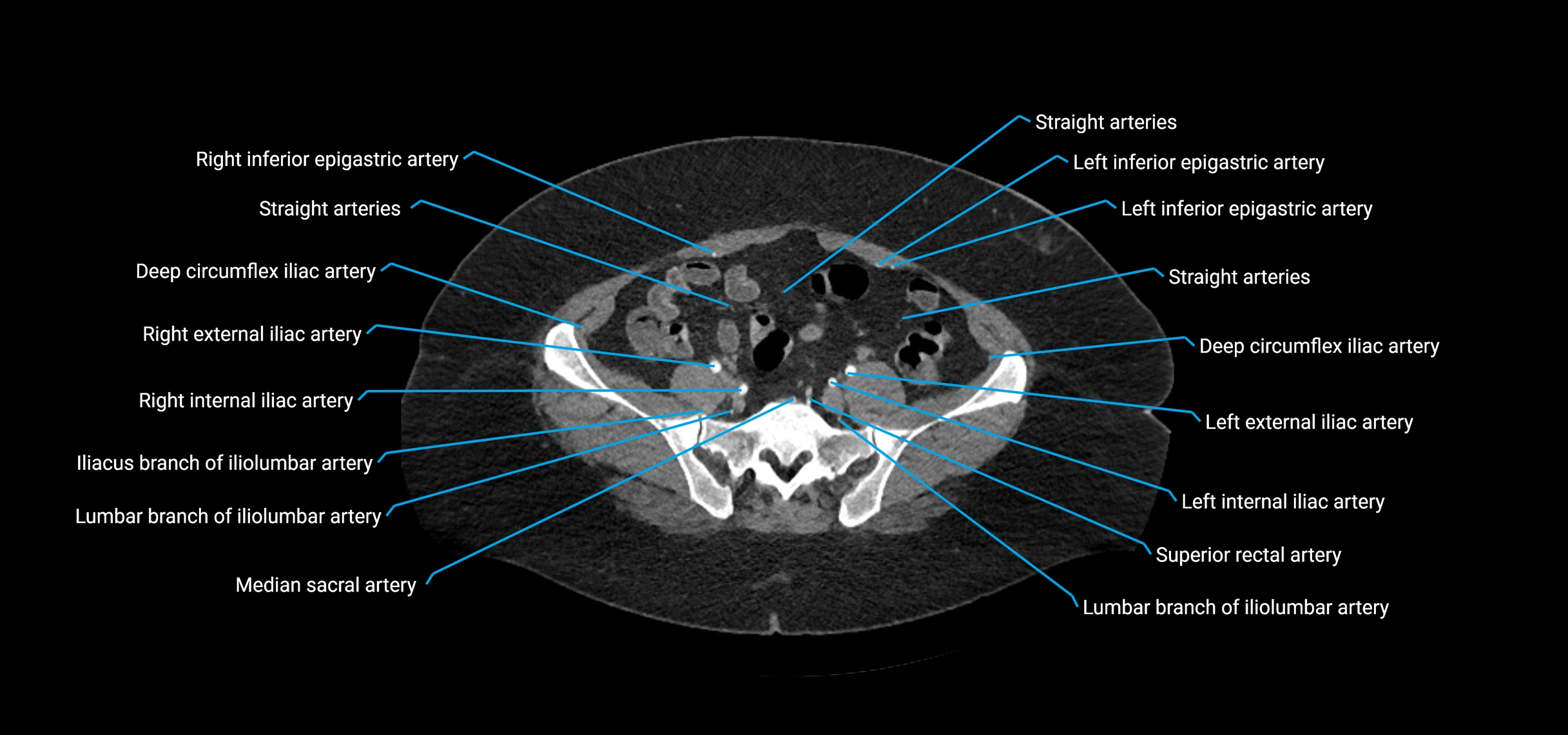 CTA abdomen axial cross sectional anatomy labelled image_185 (2).webp